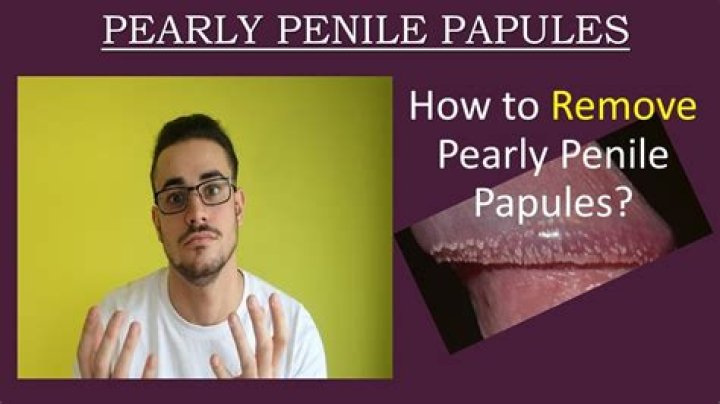 Can you Squeeze Pearly Penile Papules? Be Cautious of Scarring