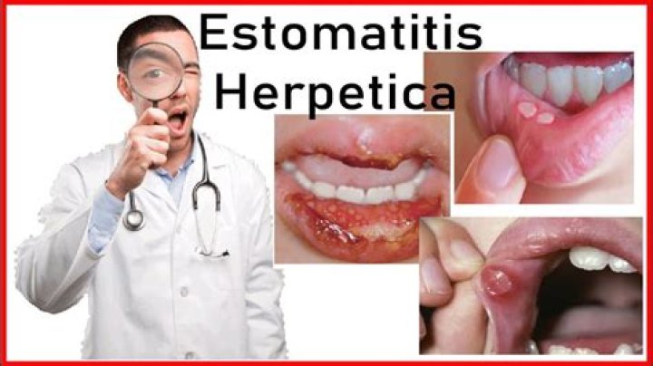 Estomatitis herpética