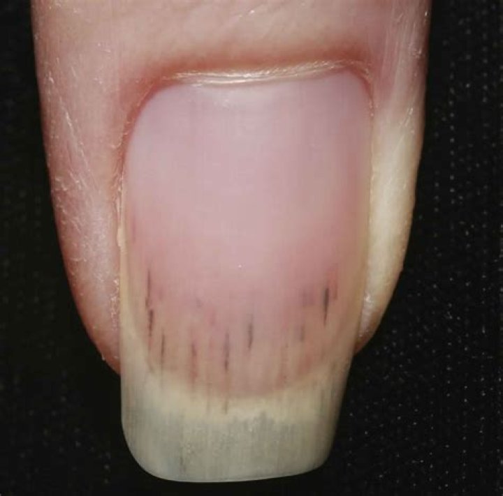 Splinter hemorrhages